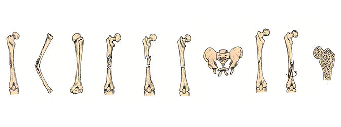 Fraturas: múltiplas, por encurtamento ou torção, completa ou incompleta, de impacto, oblíquas, epifisárias e penetrantes, por fadiga, fechadas ou abertas (Reprodução)