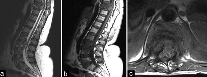 (a,b) T2W e T1W da coluna vertebral mostrando destruição do dorso-lombar devido à tuberculose da coluna T8/T9 com alguns preservação do disco. (c) T1W axial da mesma coluna mostrando compressão da medula (Reprodução)