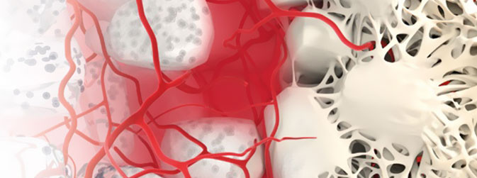 Substitutos ósseo sintético . Synthetic bone substitutes . Sustitutos óseos sintéticos