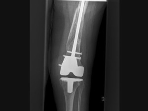 Pseudoarthrosis 03